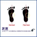 Flat Foot Shoe Insoles - Result of Health Drink