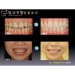 Orthognathic Surgery Recovery - Result of Dental Esthetics