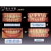 Temporary Dental Crown - Result of Dental Esthetics
