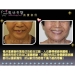 Cosmetic Dental Implants - Result of Nonwoven Surgical Gown