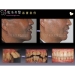 Painless Dental Implants - Result of Cosmetic Dental Implants
