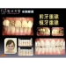 Laser Tooth Whitening - Result of Agar Gel