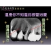 Root Canal Treatments - Result of dental