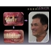 Tooth Surgery - Result of Dental Implant Recovery