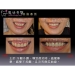 Dental Corrective Surgery - Result of rare earth magnet
