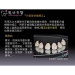 Teeth Straightening - Result of Porcelain Plates