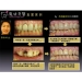 Dental Implants Front Teeth - Result of Dental Prosthetics