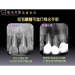Apical Surgery - Result of Dental Prosthetics
