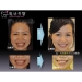 Full Mouth Reconstruction Implants - Result of Tissue Homogenizer