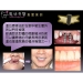 Immediate Dental Implants - Result of Vital Enzyme